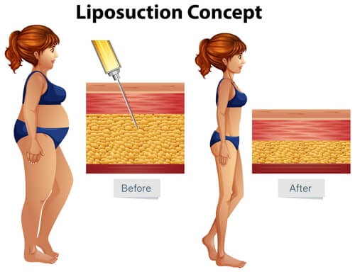 liposuction athens ga